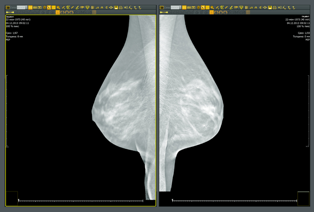 Томосинтез: вариант раскладки маммограмм в протоколе